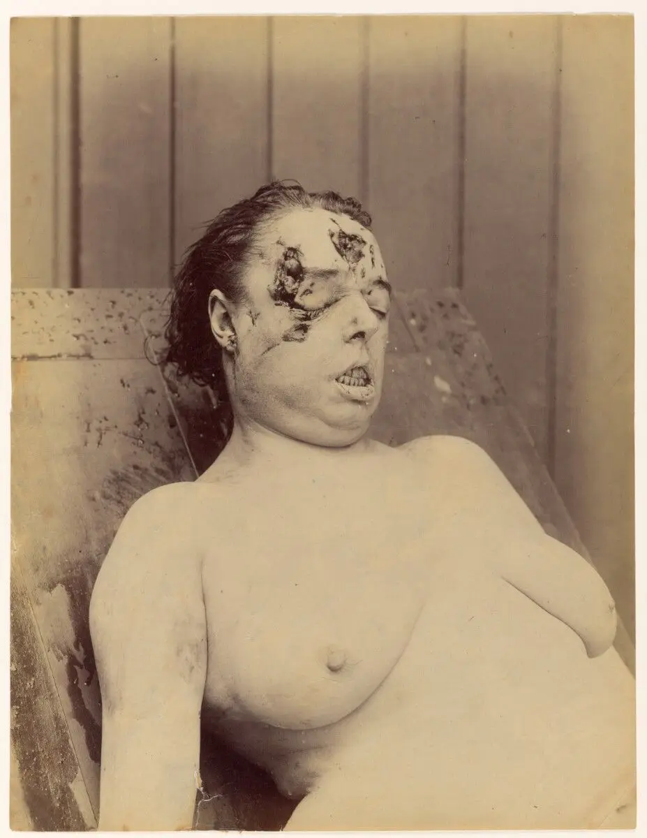 Crime de la Rue Fontaine … Augustine Durand à la Morgue by Alphonse Bertillon