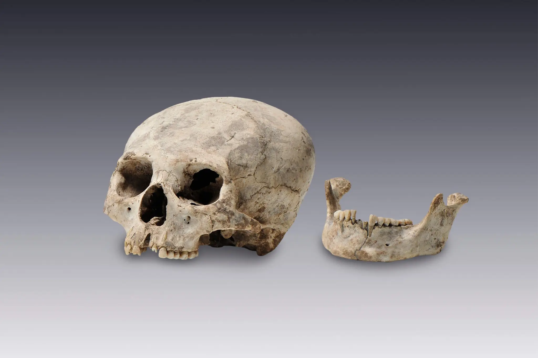 Craneo con deformacion intencional by Desconocida