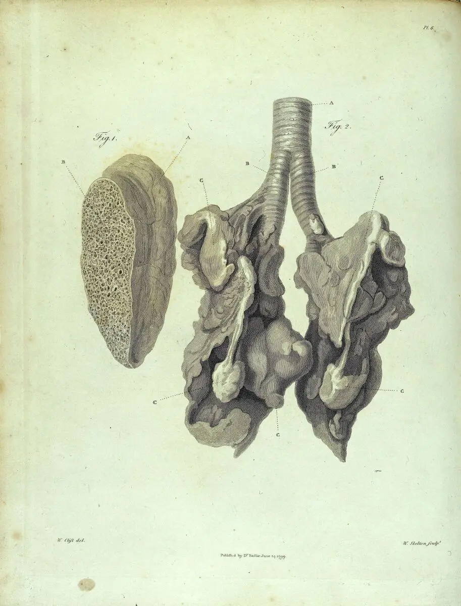 Section of diseased lung and ossification of lung by William Clift